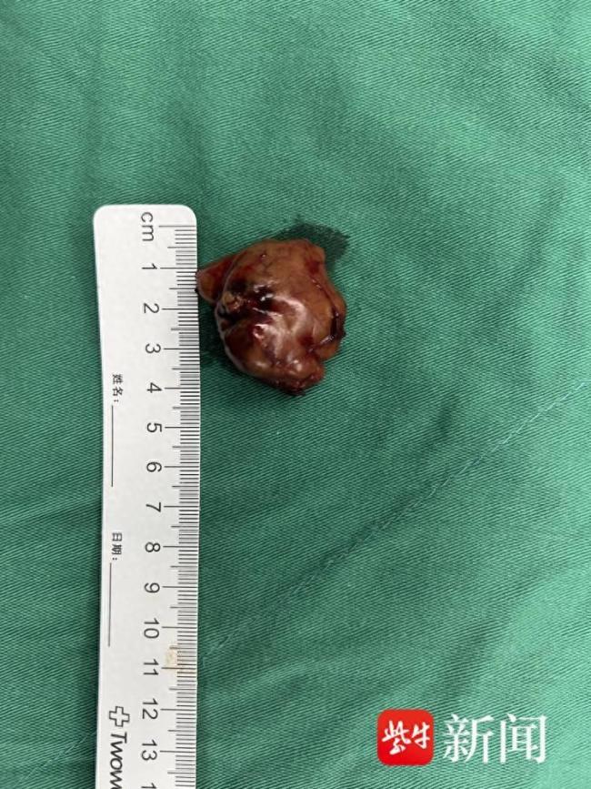 女子莫名恶心呕吐，确诊甲状旁腺肿瘤，吐到瘦十斤可谓受尽折磨